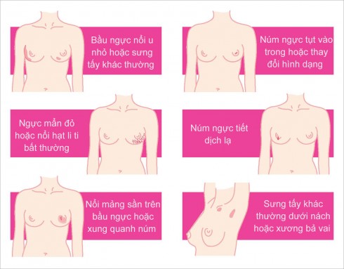 Những biểu hiện của bệnh ung thư vú cần phải phát hiện sớm để nhận được điều trị kịp thời