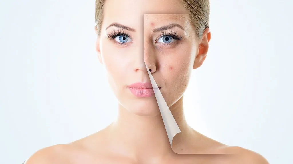 da bị mụn (1) da bị mụn (1)