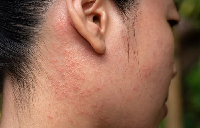 Bức tranh toàn cảnh về làn da khi bạn quá lạm dụng treatment: AHA, BHA Bức tranh toàn cảnh về làn da khi bạn quá lạm dụng treatment: AHA, BHA